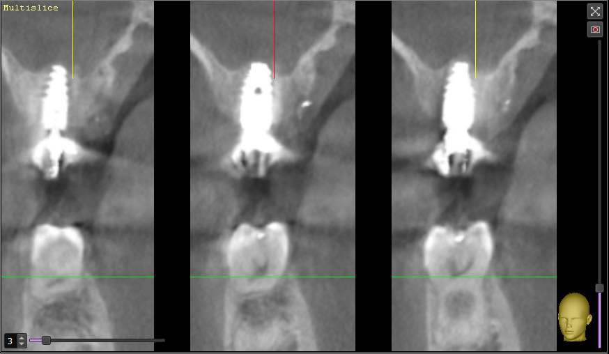 Après : greffe osseuse et pose d’implant – Cabinet Dr Laith Glissa à Msaken (Sousse)