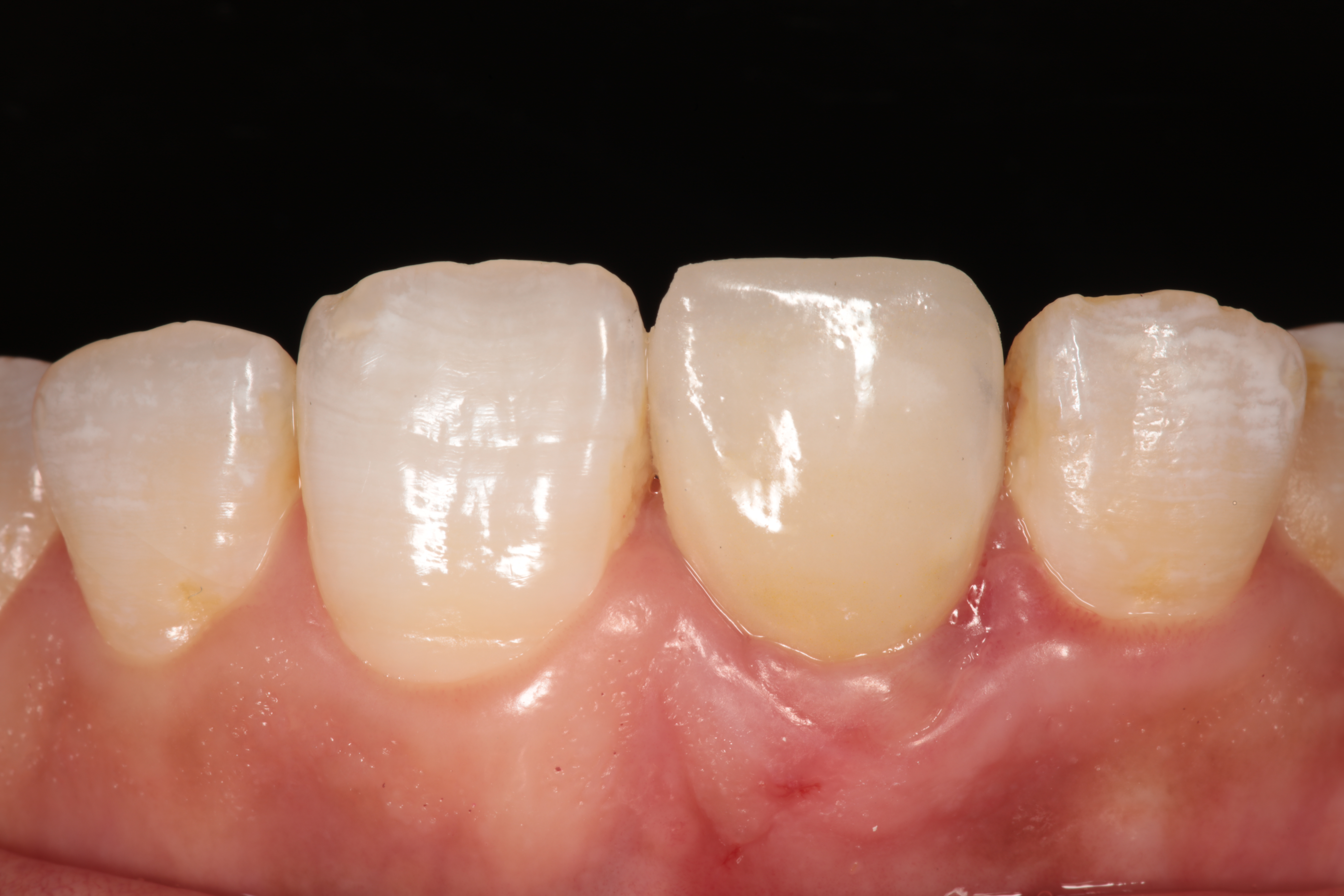 Après : implant unitaire incisive avec couronne céramique – Cabinet Dr Laith Glissa, Msaken (Sousse)