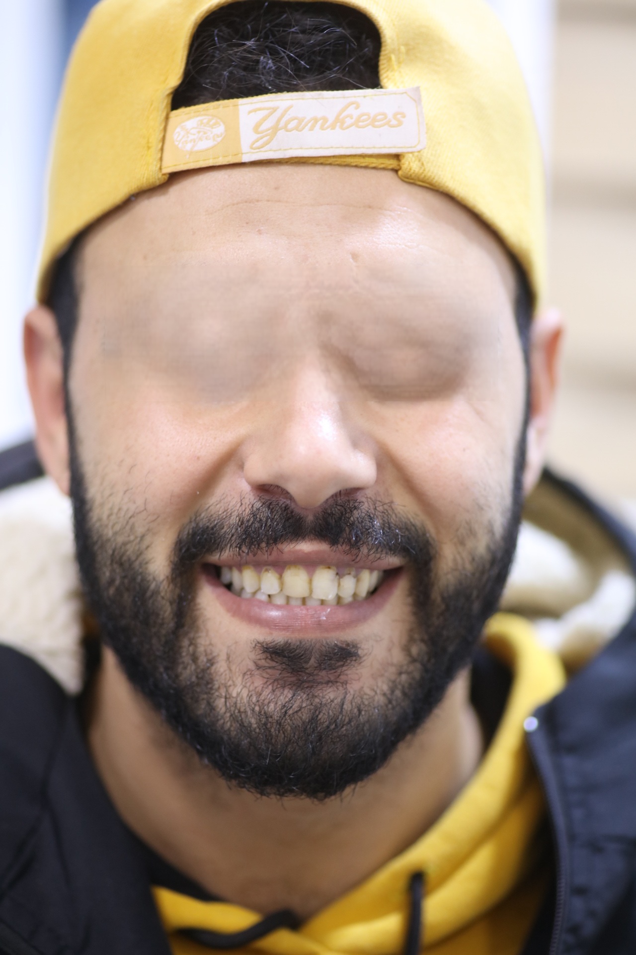 Après : facettes (veneers) secteur antérieur – Cabinet Dr Laith Glissa à Msaken (Sousse)