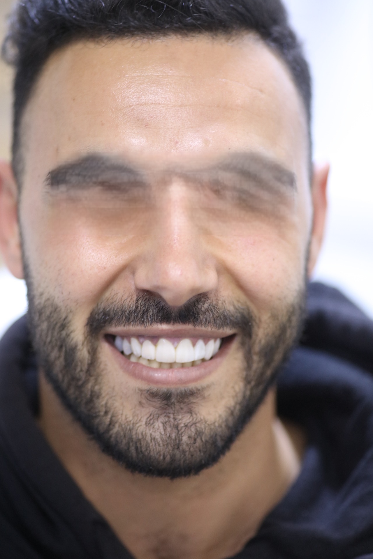 Avant : désalignements et teinte non uniforme – Cabinet Dr Laith Glissa, Msaken (Sousse)