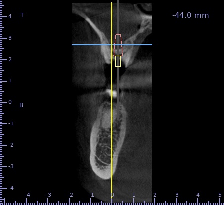 Avant : déficit osseux nécessitant greffe – Cabinet Dr Laith Glissa, Msaken (Sousse)