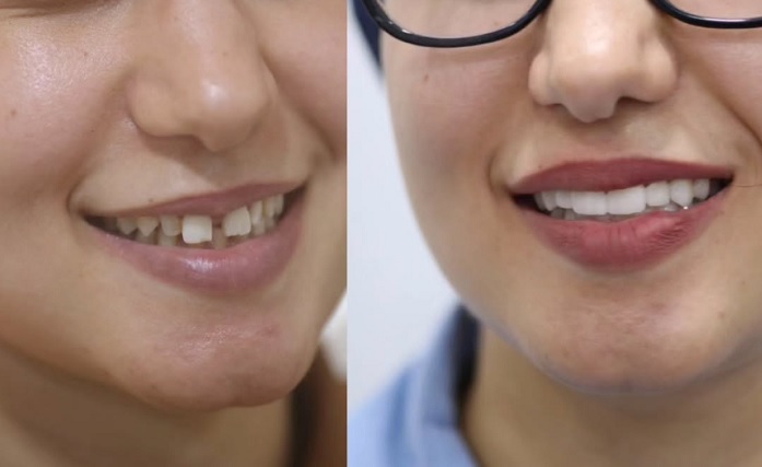 Galerie avant / apres – Dr Laith Glissa